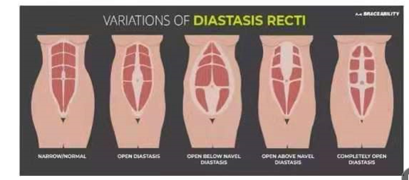 腹直肌分離如何分類(lèi)？腹直肌分離修復(fù)