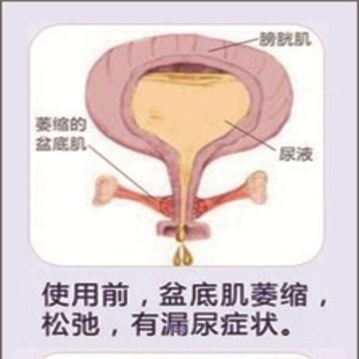 產(chǎn)后盆底肌康復(fù)|“社交癌”盯上你了嗎？