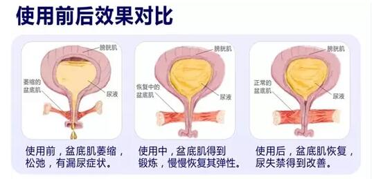 盆底康復(fù)治療怎么做？產(chǎn)后盆底功能檢測(cè)很重要