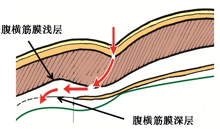 產(chǎn)后腹直肌分離如何康復(fù)，腹直肌修復(fù)那點(diǎn)事