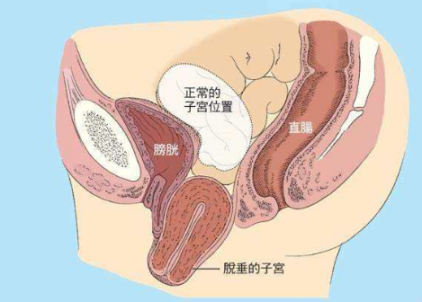 人們常說，產(chǎn)后女性做好盆底肌修復是關鍵，但盆腔器官的脫垂你也得注意