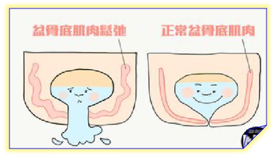 盆底康復(fù)治療怎么做，盆底肌修復(fù)常見的十大問題（中）