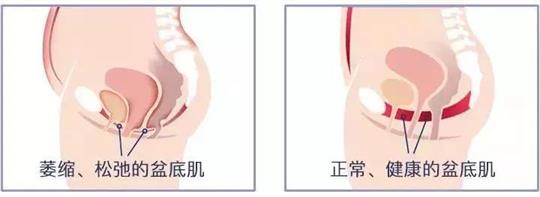 尿失禁治療儀器，不再詢問盆底康復(fù)治療有用嗎這類無意義問題