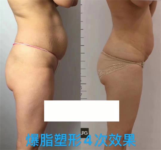 產(chǎn)后塑形美雕儀，生完孩子真的很難恢復身材？未必……