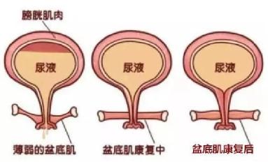 尿頻尿急尿不盡？或者可以試試盆底肌修復(fù)儀器電刺激