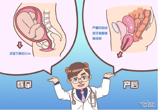 引起子宮下降可用盆底肌修復儀器干預