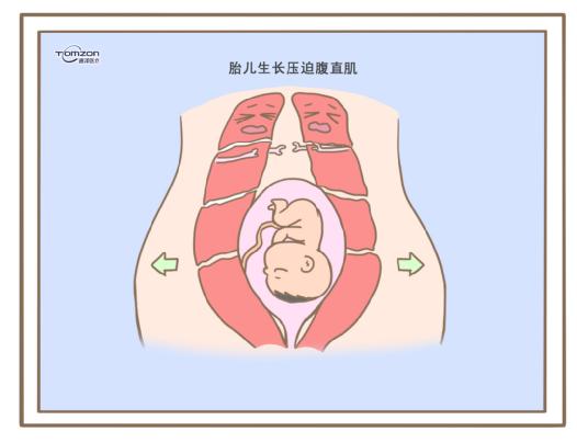 腹直肌分離可以使用盆底肌修復(fù)儀器嗎？