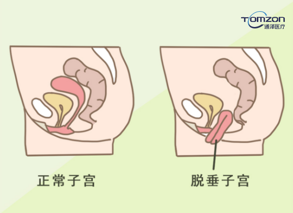 盆底康復(fù)治療儀能夠改善什么樣的情況？