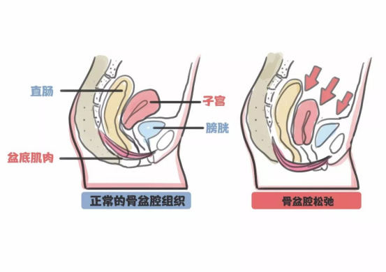 骨盆修復(fù)