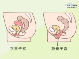 盆底肌修復儀器