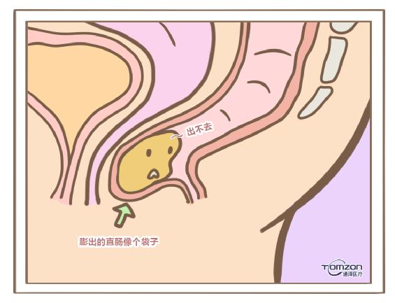 盆底肌修復(fù)儀器.jpg